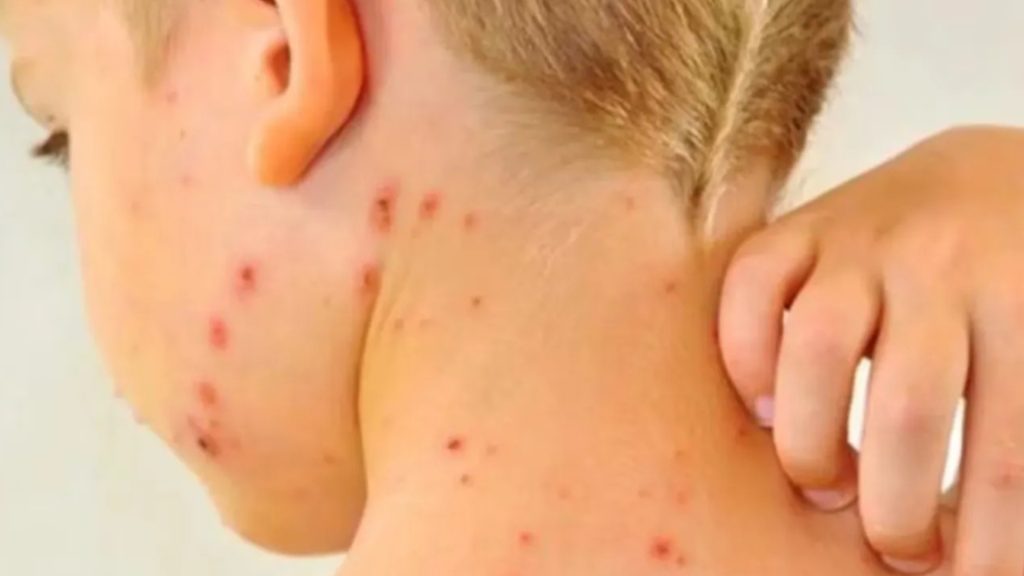 casos-sarampion-aumentan-mexico-alerta-unam