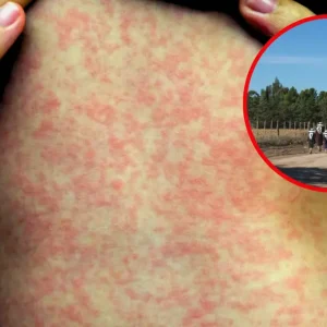 EU Ordena el Cierre de Instalaciones de ICE en Texas por Brote de Sarampión