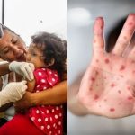 Nueva York declara emergencia por brote de sarampión; suma 108 casos en el año